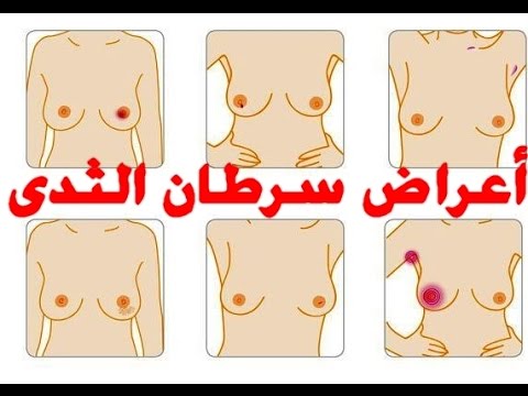 ماهية اعراض سرطان الثدي - كيف تعرفي انه عندك سرطان 4062 2