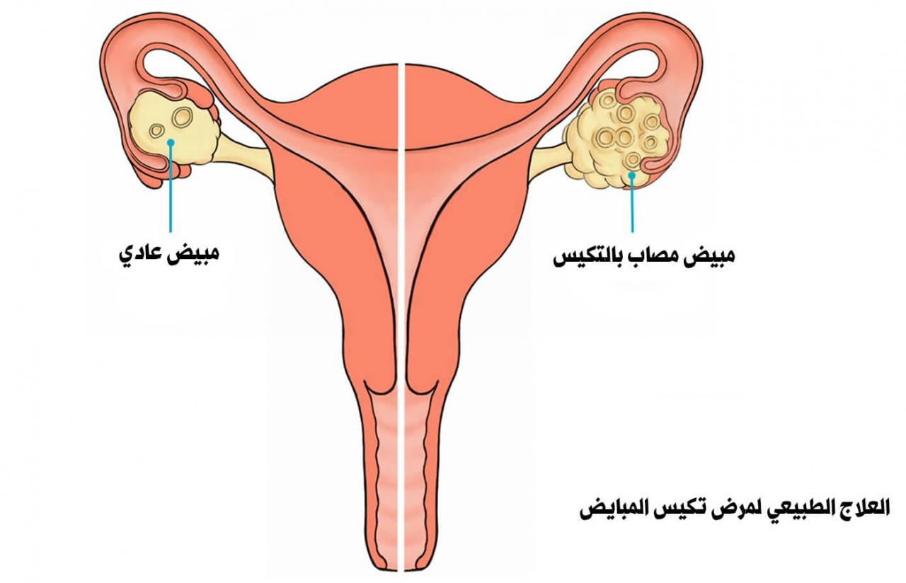 اسباب تكيس المبايض عند النساء - تكيس المبايض واسبابه وكيغيه علاجه 798 2