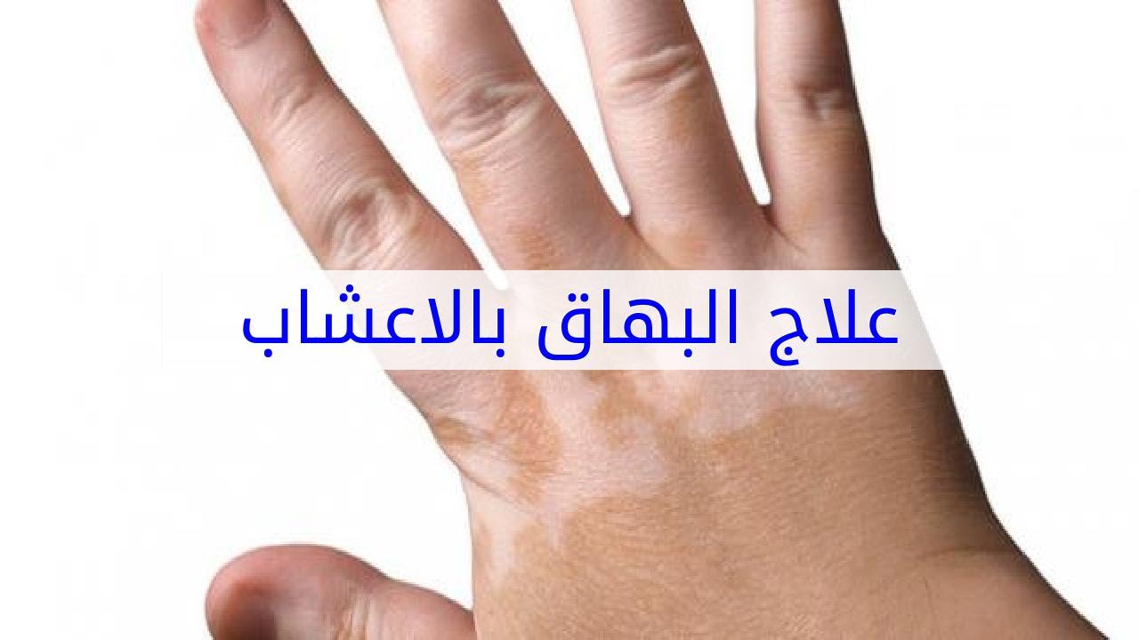 طرق علاج البهاق , تخلص من بقع البهاق بااشياء بسيطه