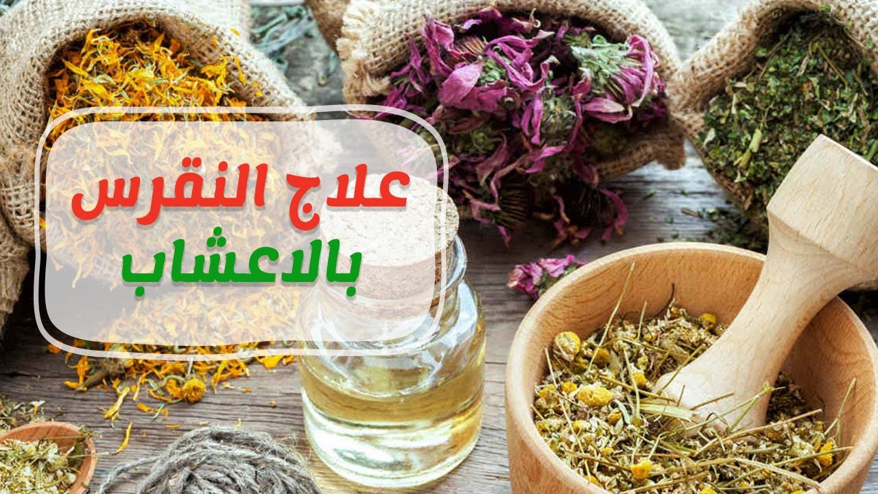 اعشاب لعلاج النقرس , قمه الدهشه من مفعول هذا الاعشاب