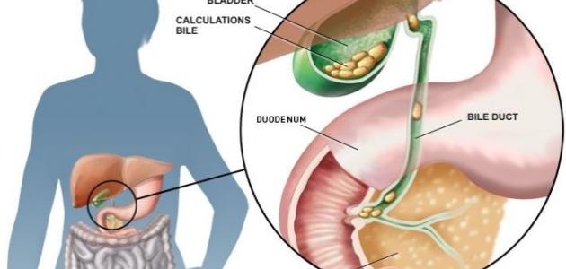 اسباب الحصوة في المرارة - تعرفي علي حصوه المراره وسببها 4061 3