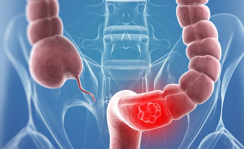 اعراض سرطان القولون المبكرة - علاج سرطان القولون بالاعشاب 1968 1