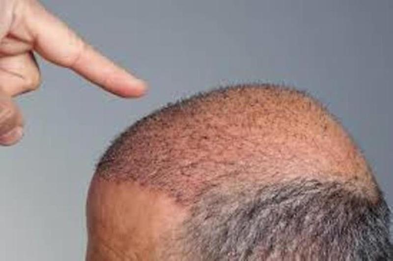 زراعة الشعر في الكويت - تخلص من الصلع الوراثي 252 5