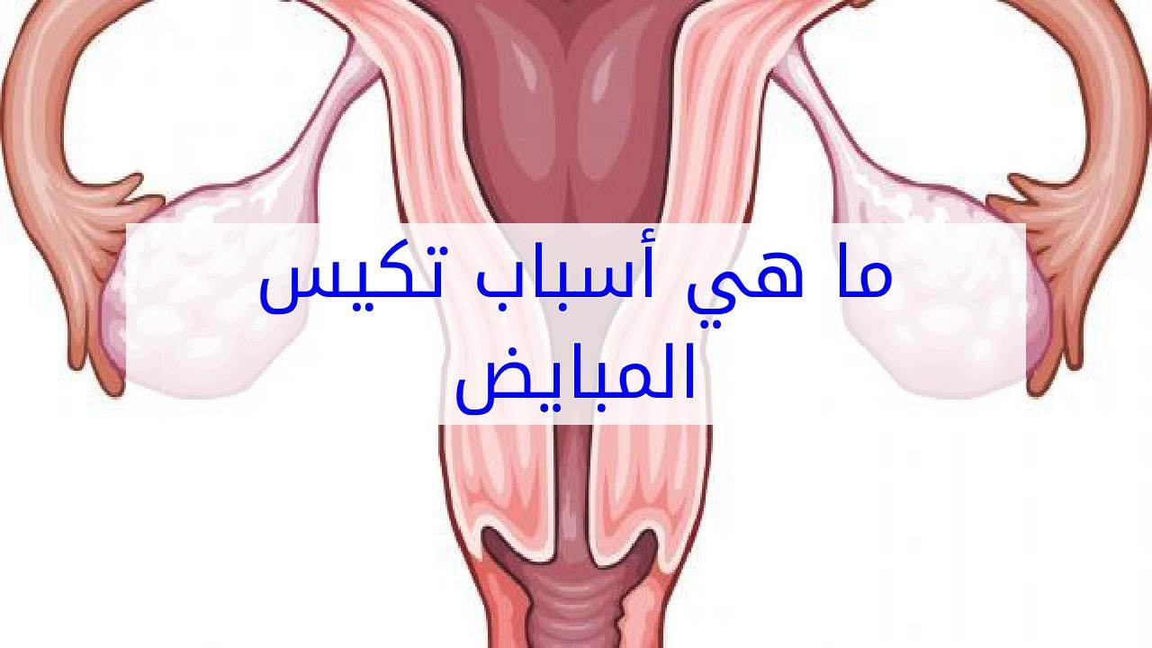 اسباب تكيس المبايض عند النساء - تكيس المبايض واسبابه وكيغيه علاجه 798 1