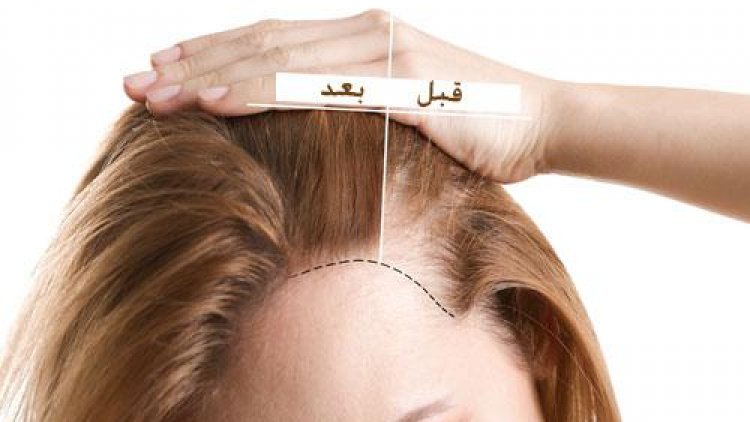 تكلفة زراعة الشعر في مصر 2019 - اخلص من كابوس الصلع المبكر 321 10