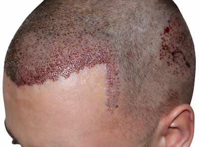 اضرار زراعة الشعر الطبيعي , ومخاطر زراعه الشعر