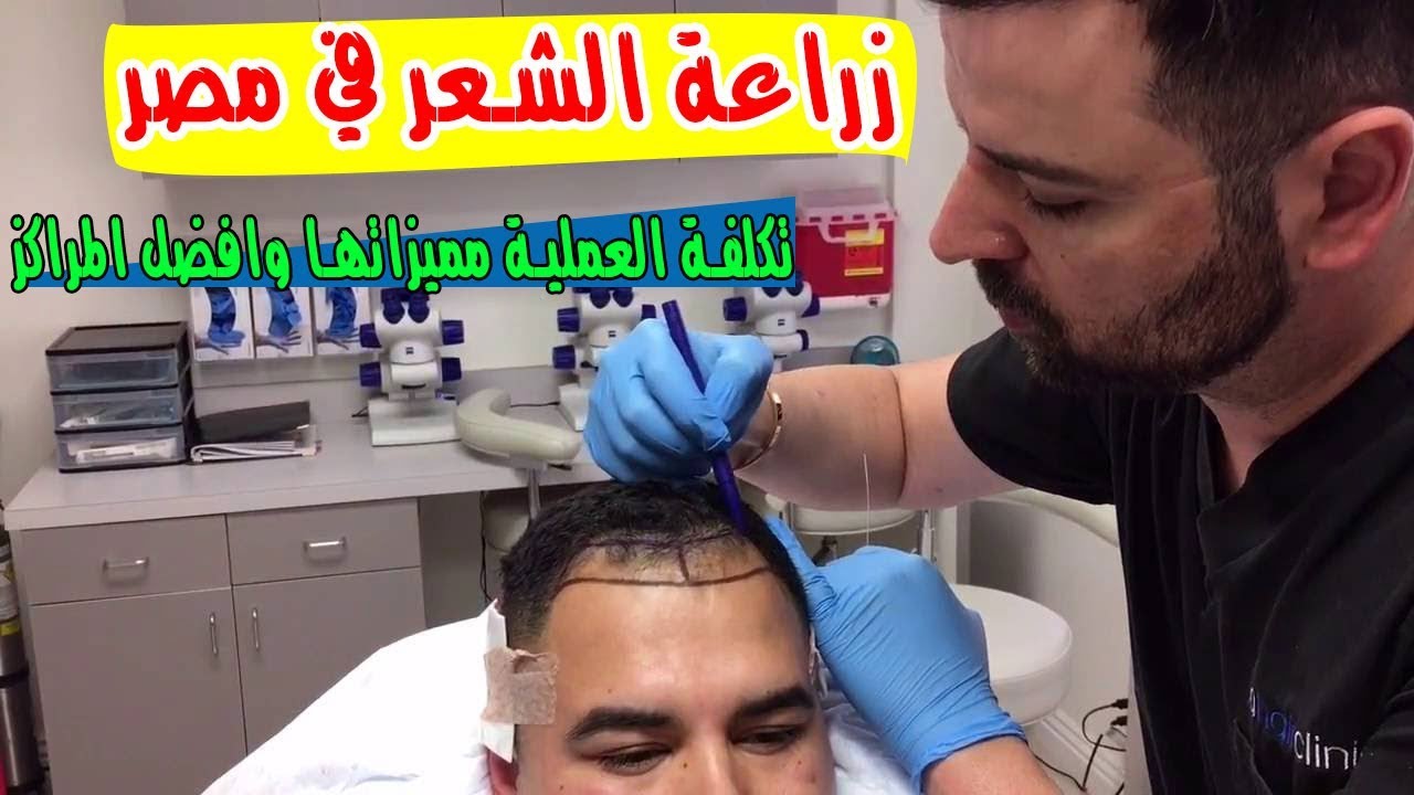 تكلفة زراعة الشعر في السعودية - وداعا للصلع من الان 3925 3