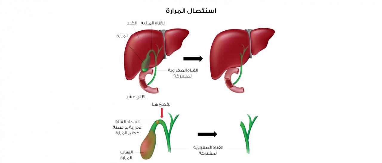 اضرار استئصال المرارة - ما لا تعرفه عن توابع العمليات الجراحيه للمرارة 3103 1