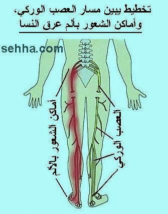 علاج عرق النسا - طرق التخلص من الم عرق النسا 3970 2