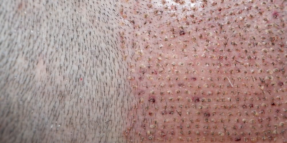 متى تثبت البصيلات بعد زراعة الشعر , اختراعات حديثه للتخلص من الصلع