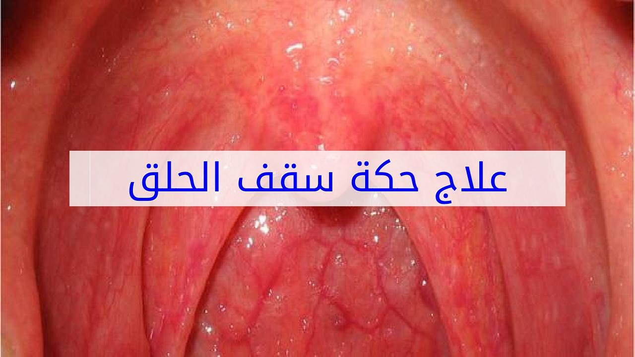 الم سقف الحلق , اسباب وطرق علاج فقاعات الحلق