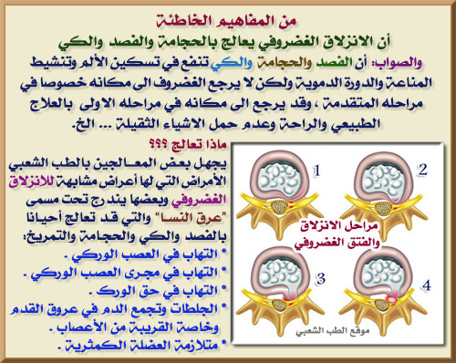 علاج عرق النسا - طرق التخلص من الم عرق النسا 3970 1