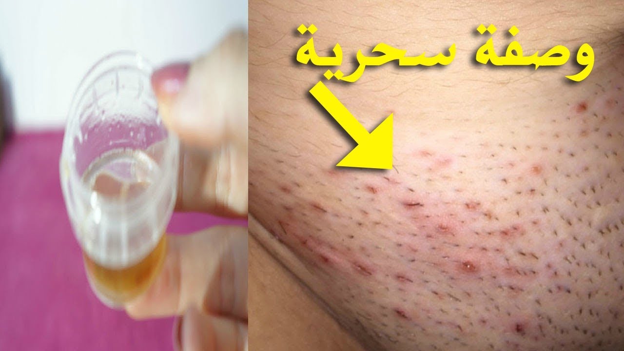 علاج حبوب المنطقة الحساسه بعد الحلاقه , العلاج الفورى السحرى لحبوب ما بعد الحلاقه