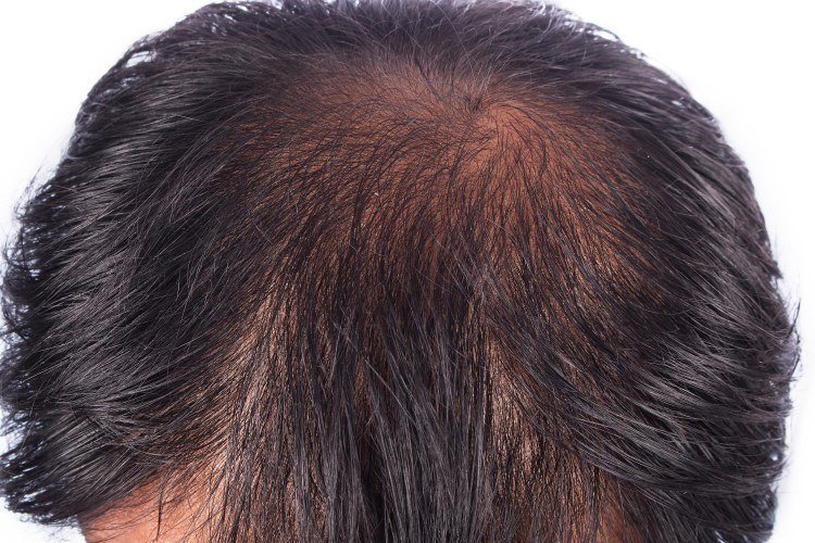 تكلفة زراعة الشعر في مصر 2019 - اخلص من كابوس الصلع المبكر 321 5